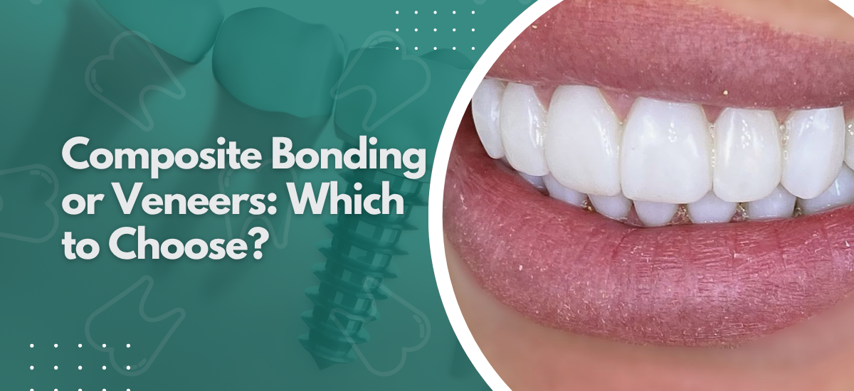 Composite Bonding or Veneers:Which to Choose?