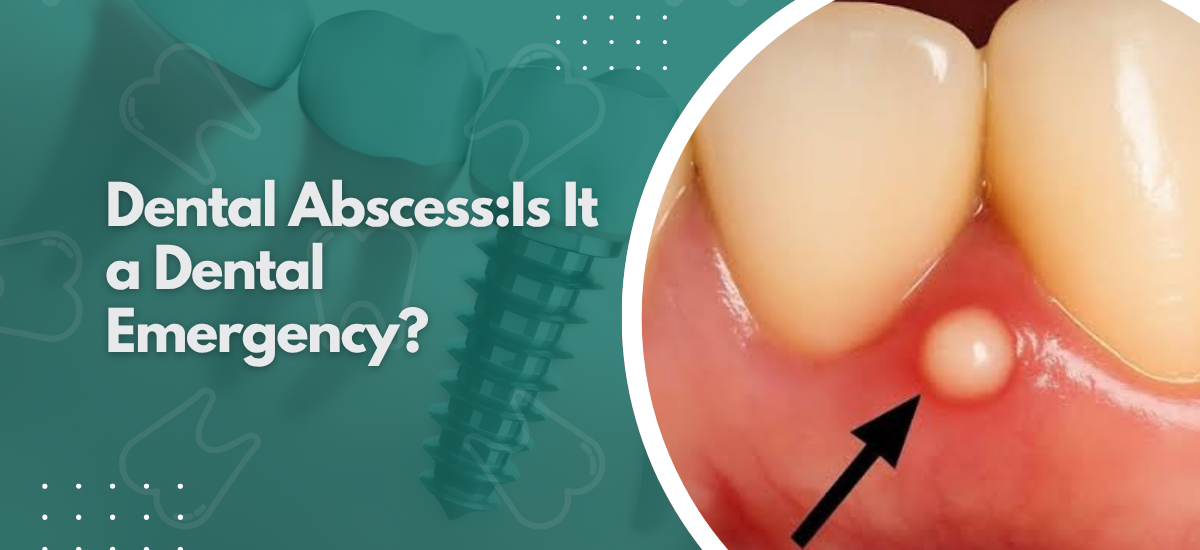 Dental Abscess:Is It a Dental Emergency?