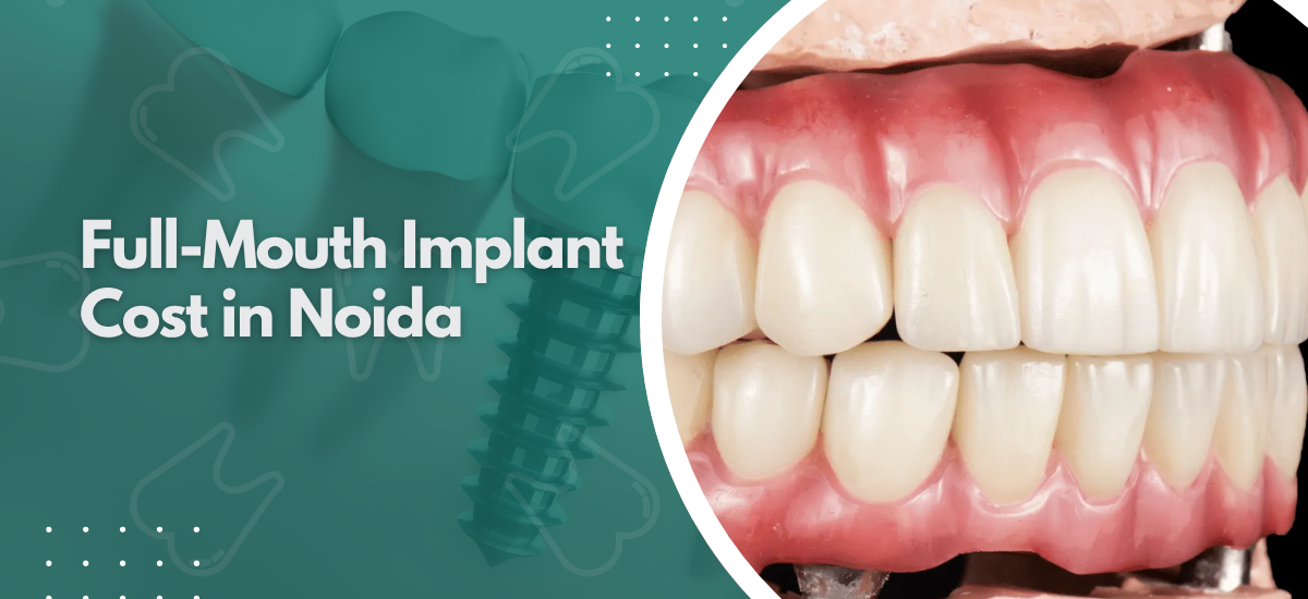  Full-Mouth Implant Cost in Noida?
