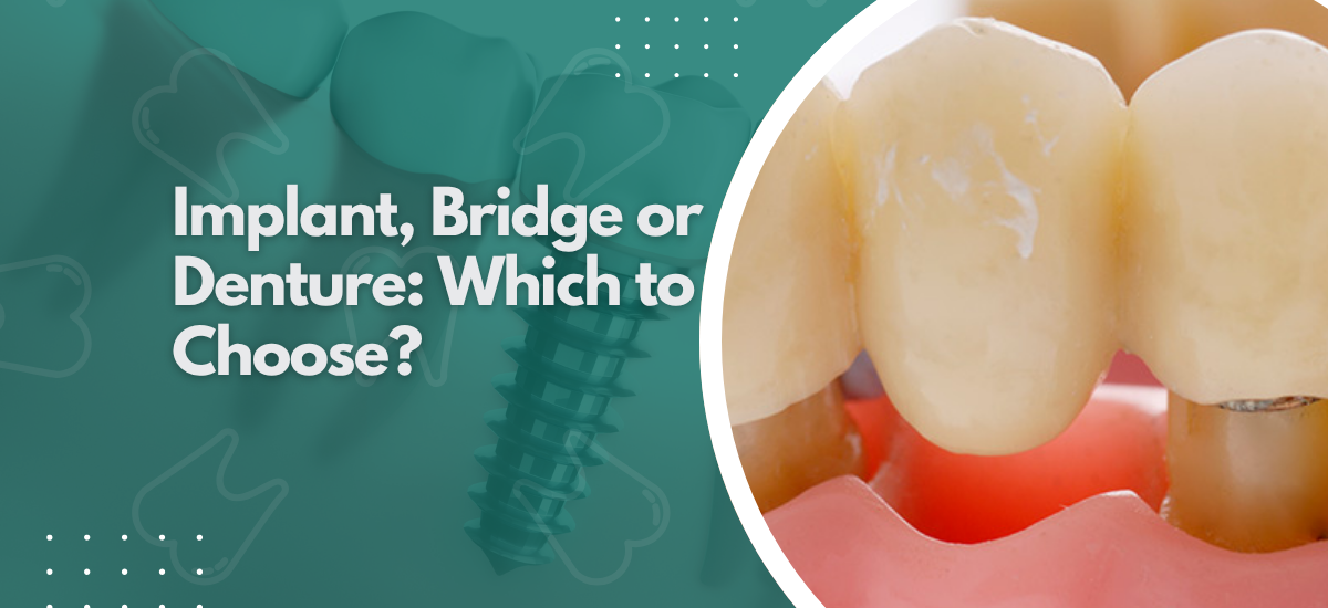 Implant, Bridge or Denture: Which to Choose?