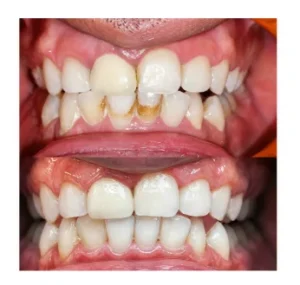 Close-up of teeth before and after whitening: top row stained and crowded, bottom row whiter and straighter.