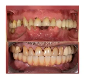 Before-and-after dental transformation: top image shows crowded, misaligned teeth with gaps and worn edges; bottom image shows a full, straight, evenly spaced set of teeth after dental treatment.