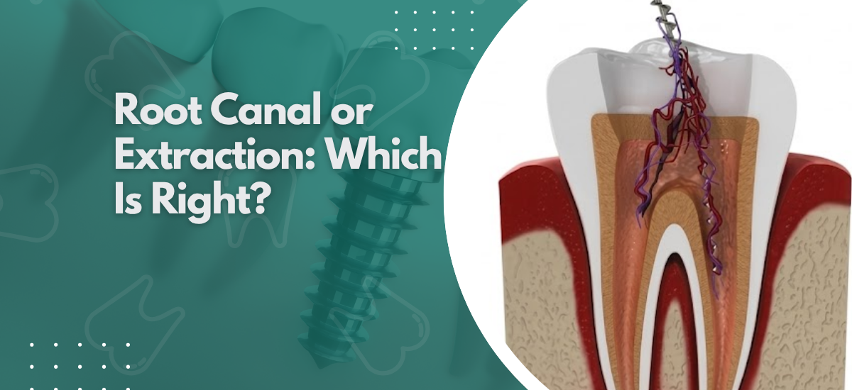 Root Canal or Extraction: Which Is Right?