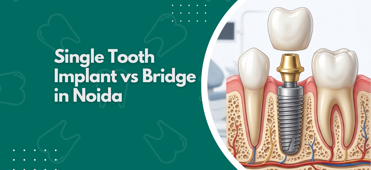 Single Tooth Implant vs Bridge in Noida?