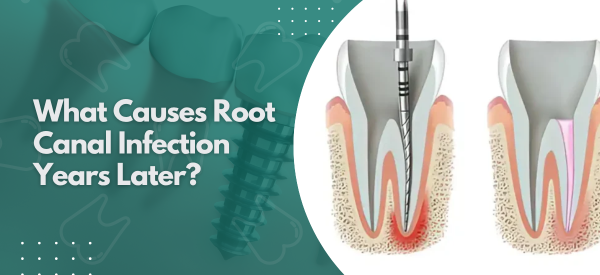 What Causes Root Canal Infection Years Later?