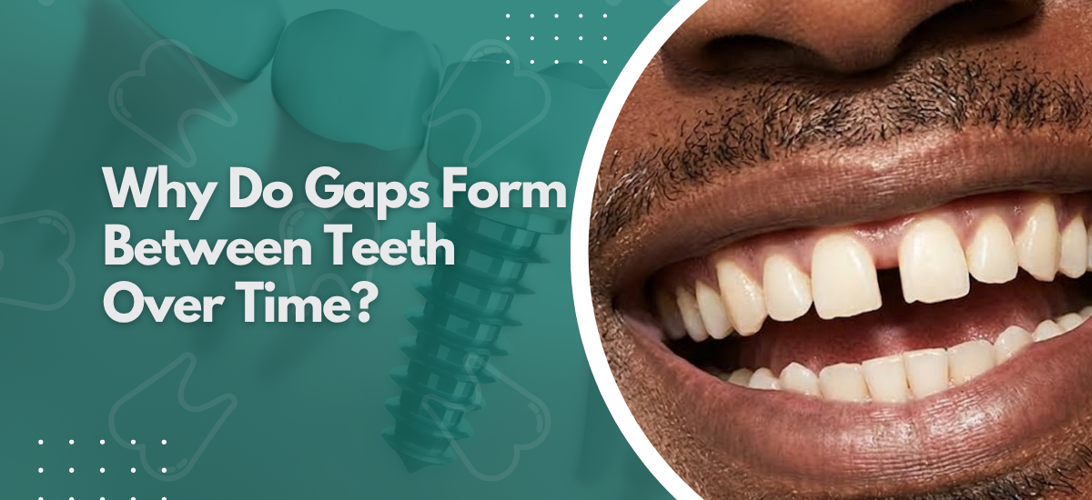 Why Do Gaps Form Between Teeth Over Time?