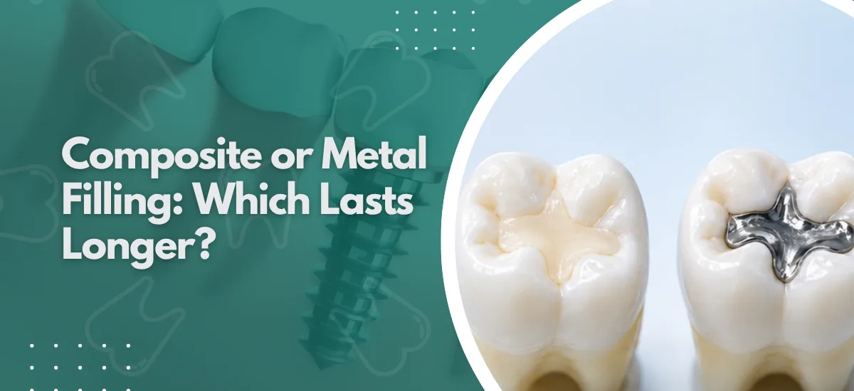 Composite or Metal Filling: Which Lasts Longer?