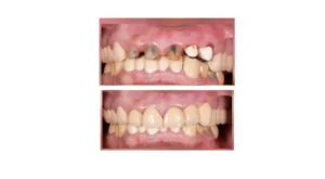 Before-and-after dental restoration: top image shows severely decayed upper teeth; bottom image shows repaired, aligned teeth with healthier gums.