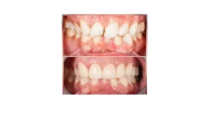 Split image: crowded, misaligned teeth on top before treatment and straightened teeth on bottom after braces.