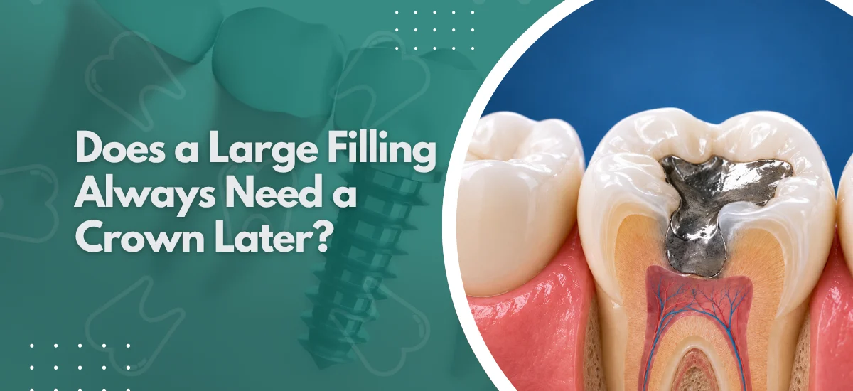 Does a Large Filling Always Need a Crown Later? 