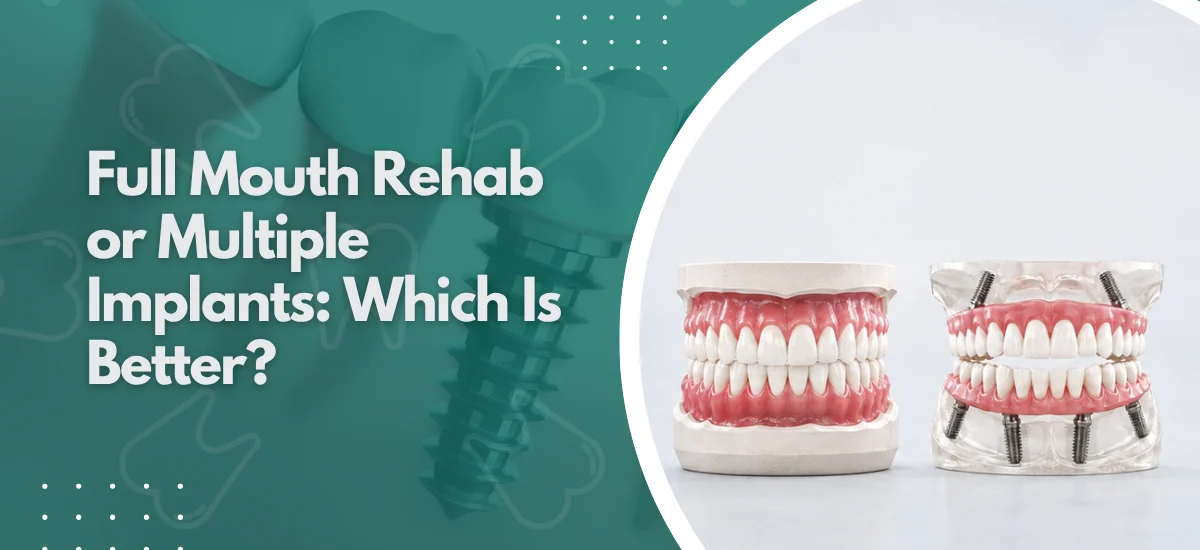 Full Mouth Rehab or Multiple Implants: Which Is Better?