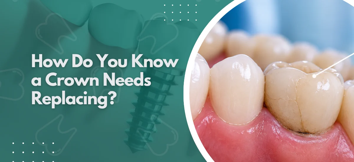 How Do You Know a Crown Needs Replacing?