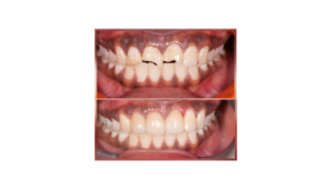 Before and after dental photo showing chipped upper front teeth before treatment (top) and restored