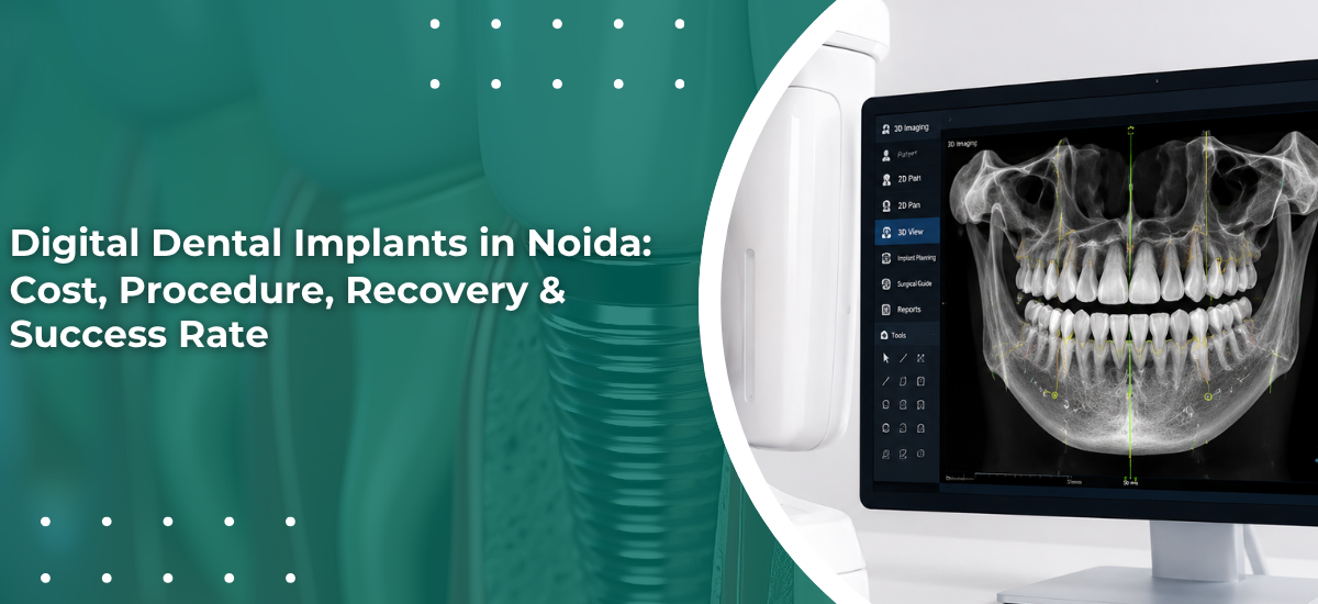 Digital Dental Implants in Noida | Cost & Procedure