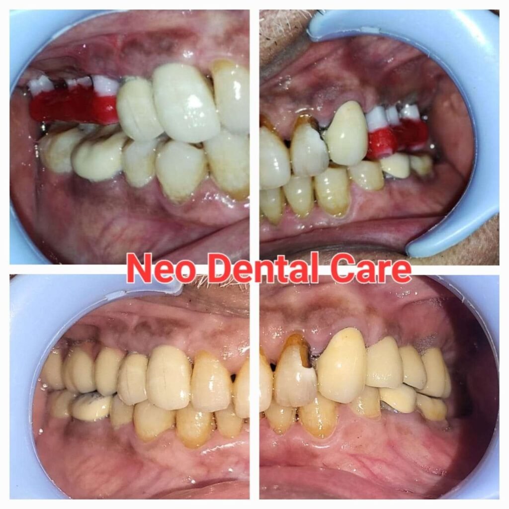 Four-panel collage showing before-and-after dental treatment at Neo Dental Care: initial damage and gum issues on top row, corrected bites and crowns on bottom row.