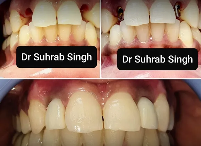 Three-panel dental treatment collage showing before-and-after teeth alignment and whitening; overlay reads 'Dr Suhrab Singh'.