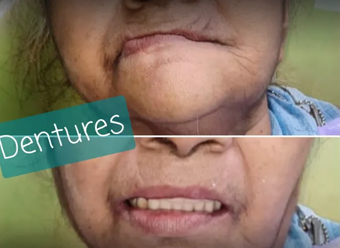 Split-screen close-up of an older person's mouth: top shows gum line without dentures, bottom shows a smile with dentures; a blue label reading 'Dentures' overlays the image.