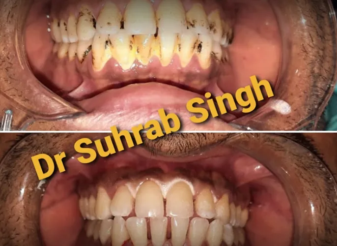 Before-and-after dental treatment: top image shows stained, plaque-covered teeth; bottom image shows cleaned, whiter teeth after care.