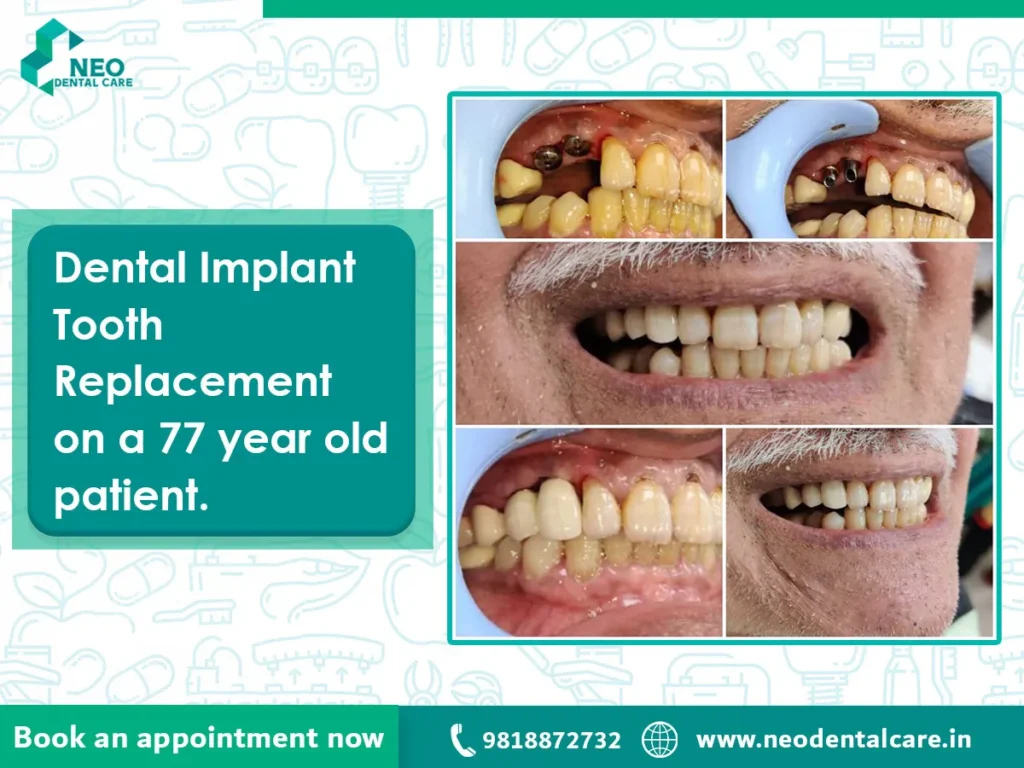 Dental-implant treatment collage: before/after photos of a 77-year-old patient’s teeth, teal callout text, Neo Dental Care branding, and a bottom banner with booking, phone number, and website.
