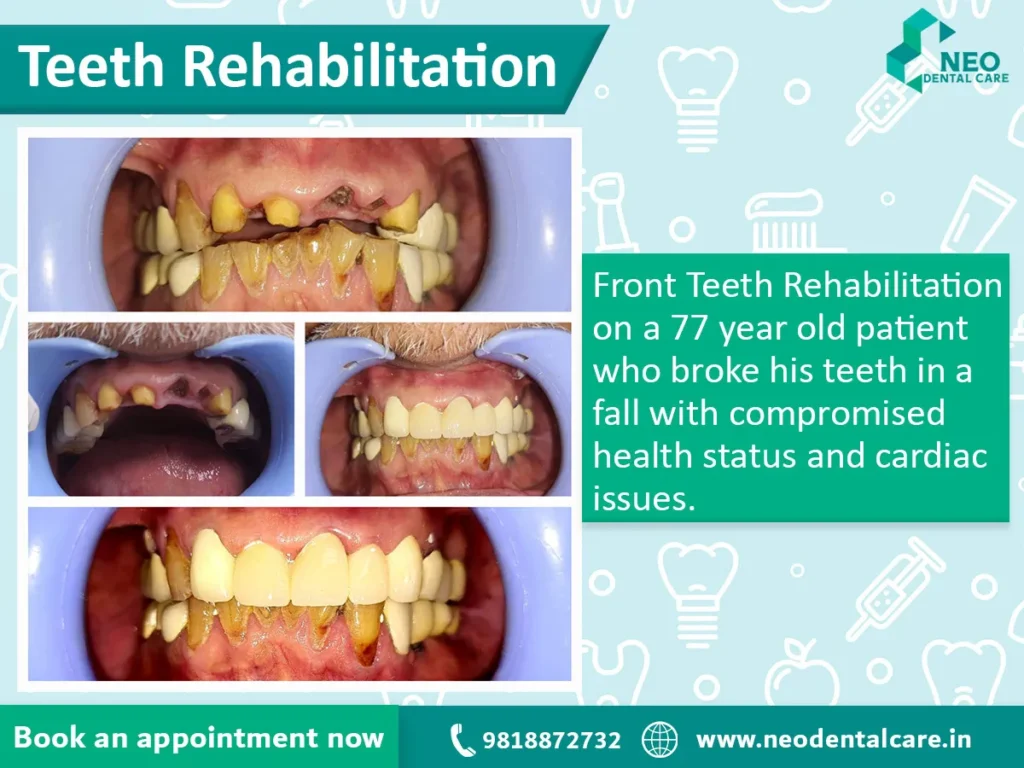 Promo image for front teeth rehabilitation: collage showing several patient teeth photos with a teal-green text panel describing a 77-year-old’s fall-related dental issues; includes booking CTA, phone, and website.