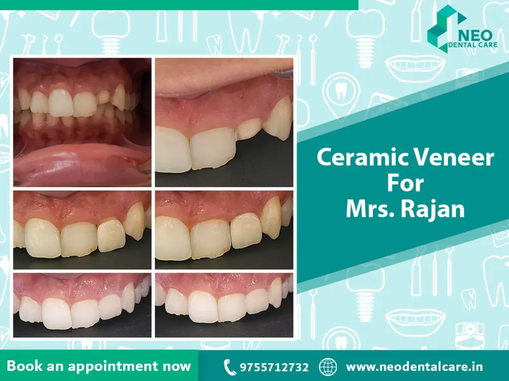 Advertisement for ceramic veneers showing six before-and-after photos of teeth alignment and whitening, labeled 'Ceramic Veneer For Mrs. Rajan' with Neo Dental Care branding.