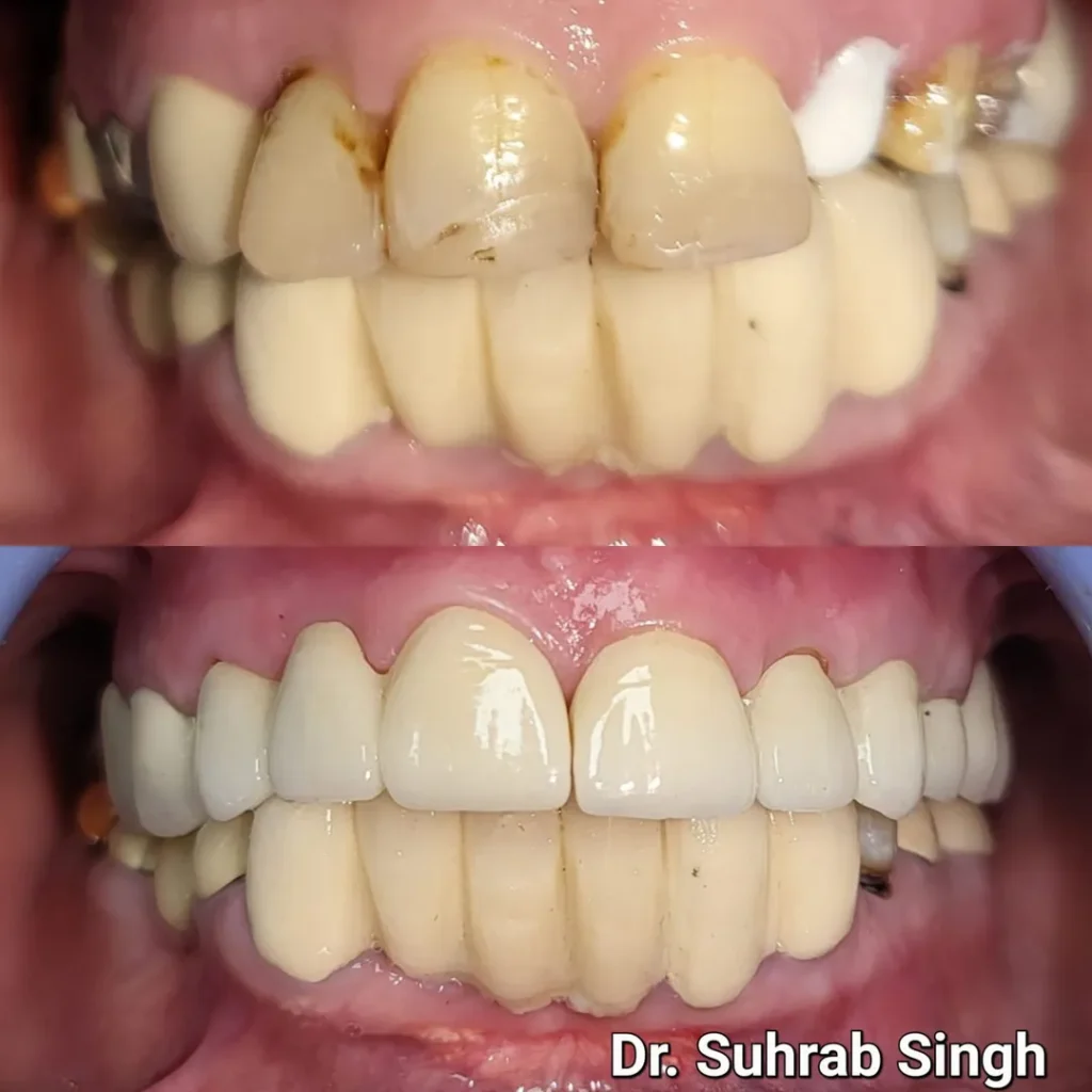 Before-and-after photos of dental restoration: top image shows stained, worn upper front teeth with restorations; bottom image shows a full-arch set of restored, evenly aligned, white teeth (veneers/crowns).