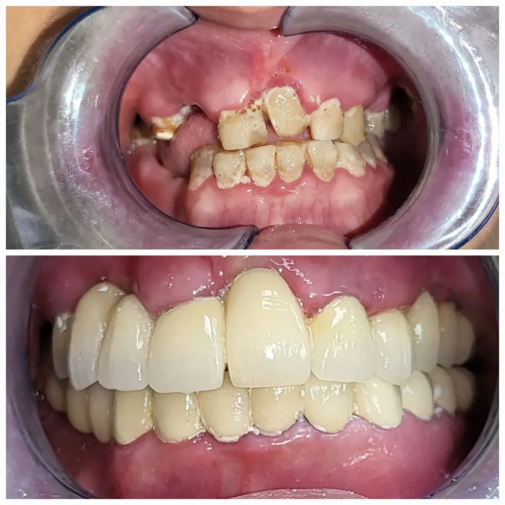 Before-and-after collage of dental restoration: left shows severe decay and missing teeth, right shows a full set of white, capped teeth.