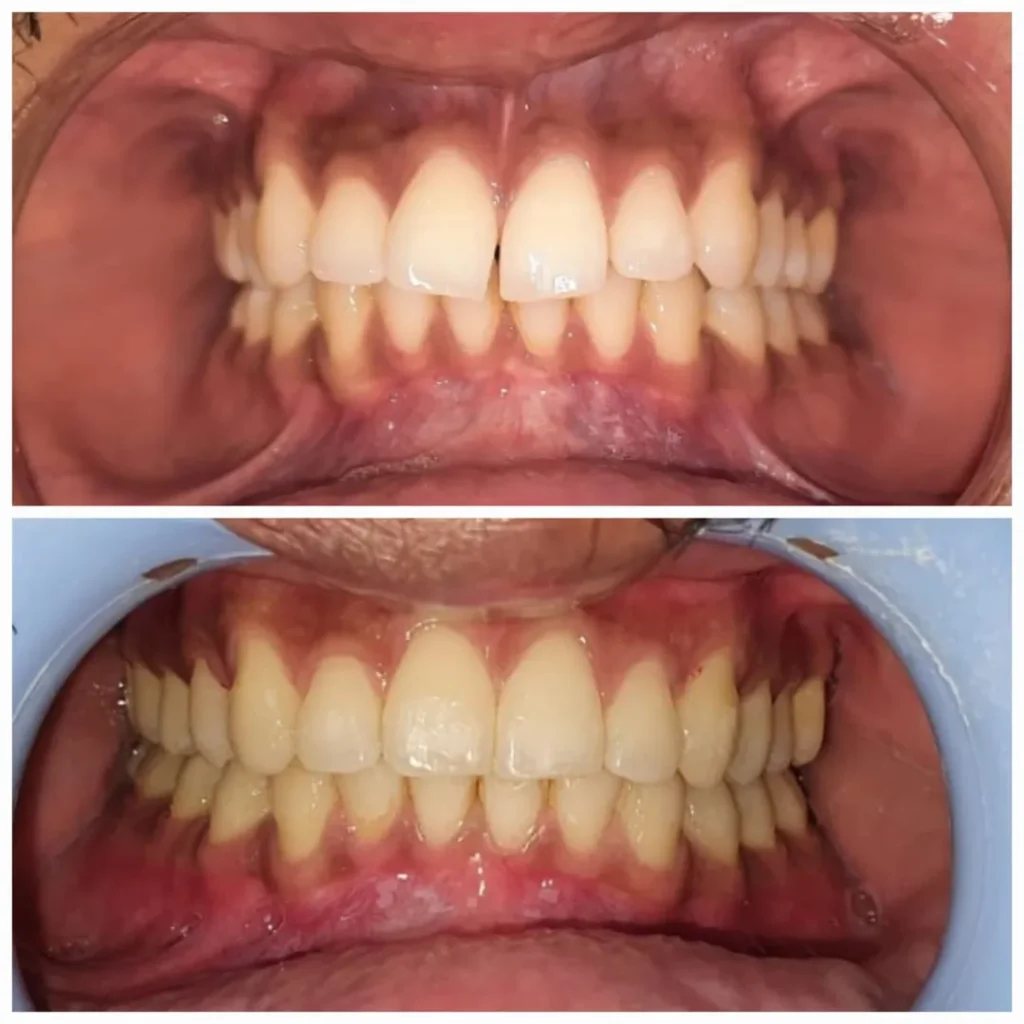 Top image shows crowded, misaligned upper teeth; bottom image shows corrected, straightened teeth after treatment (before/after).”,