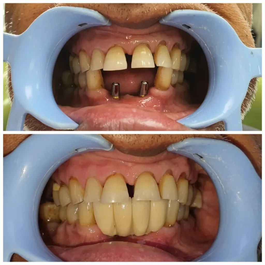 Before and after dental implant restoration: lower jaw shows two titanium implant posts, with upper teeth worn and misaligned.