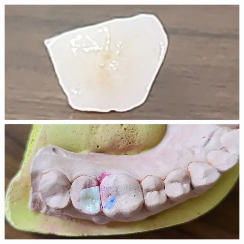 Top: a broken dental crown fragment resting on a wooden surface. Bottom: a dental cast of the lower jaw showing molars, with a tooth-colored restoration and colored marks on adjacent teeth.