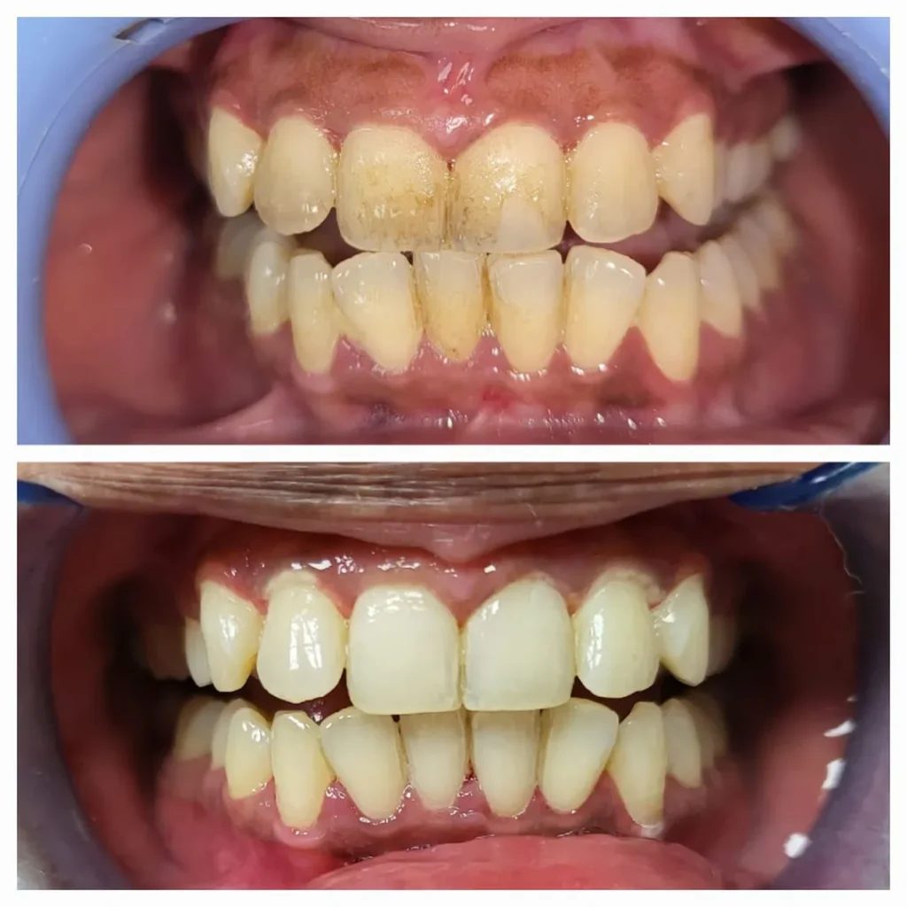 Before-and-after photos of teeth: top image shows crowded, yellowed teeth with staining; bottom image shows whiter, more aligned teeth after treatment.