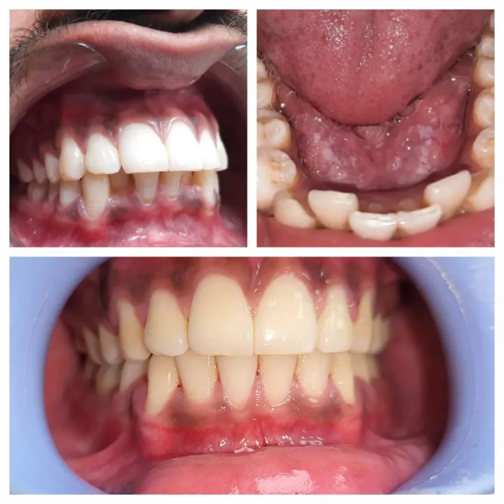 Collage of three views showing crowded, misaligned teeth and gingival inflammation.