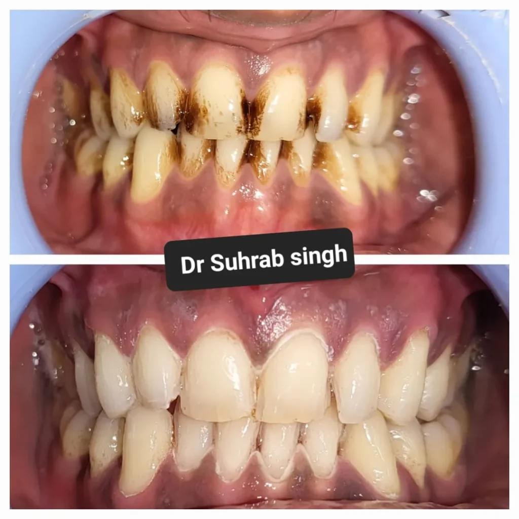 Two-panel dental comparison: top image shows heavily stained, plaque-covered upper teeth with inflamed gums; bottom image shows cleaner teeth with reduced staining and healthier gums.