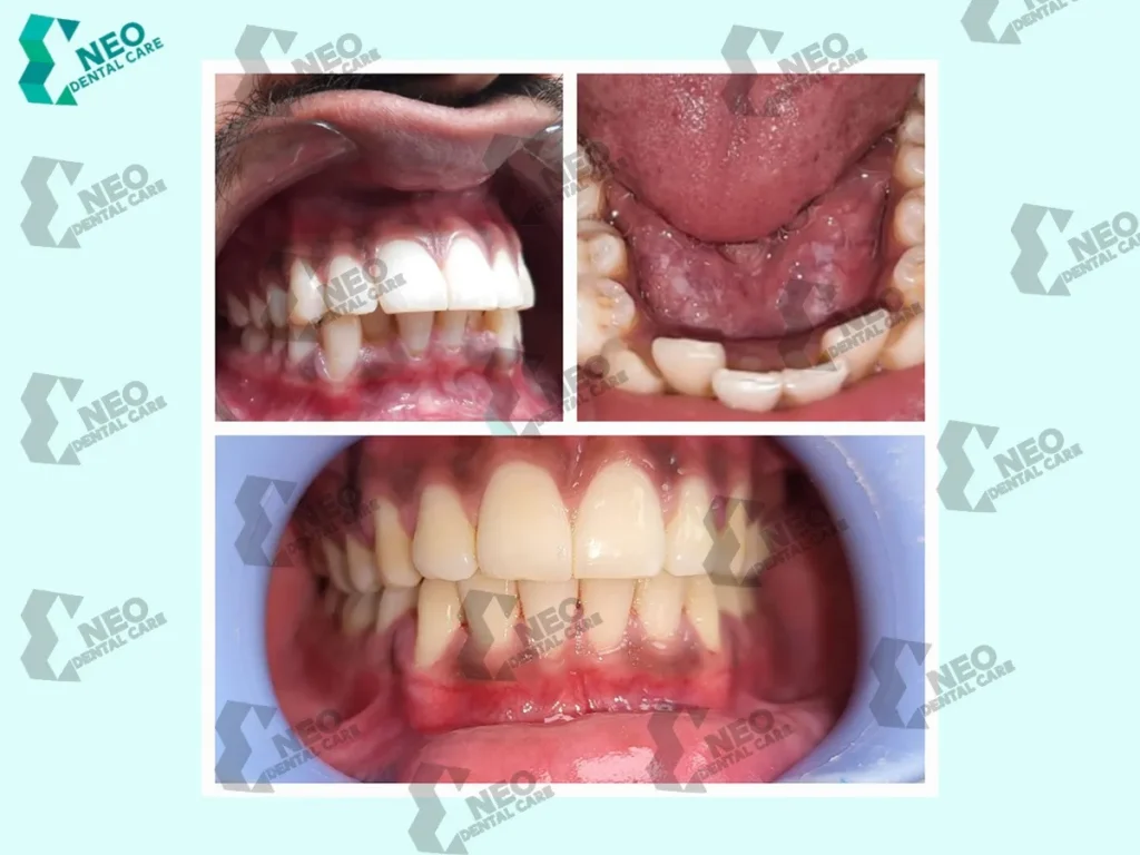 Collage showing before-and-after dental treatment: top-left crowded upper teeth, top-right inflamed gums with misalignment, bottom image of straight, evenly spaced teeth with healthy gums.