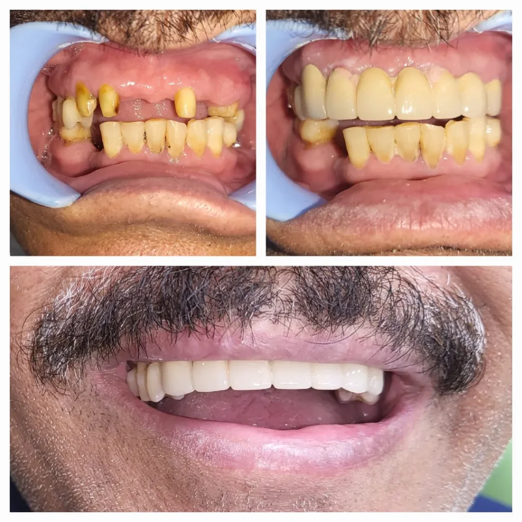 Dental transformation collage: top left shows severely decayed/missing teeth, top right shows restored teeth with a full set of prosthetics, bottom shows a close-up of a smiling mouth with white dentures