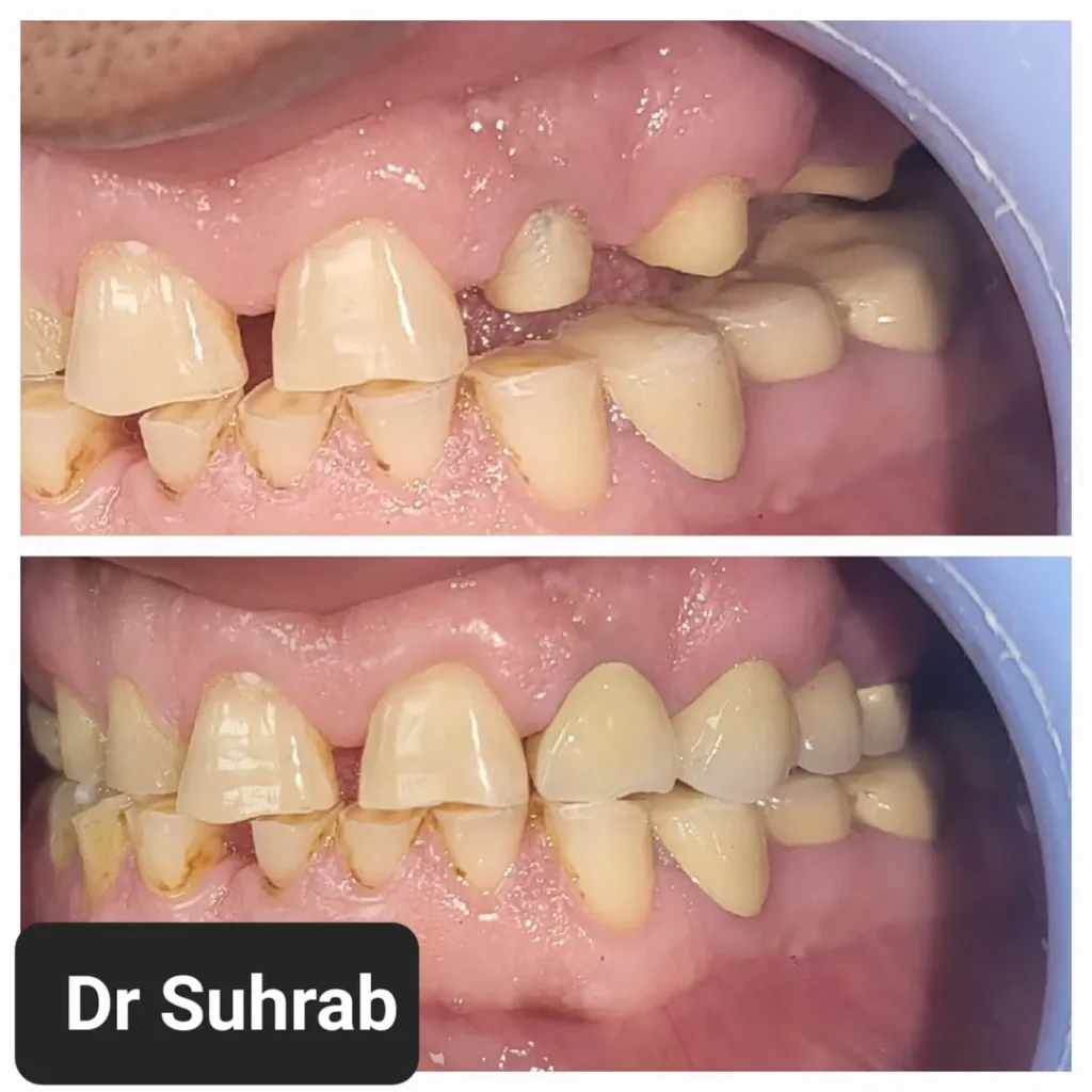 Before-and-after photos of a patient's teeth: top image shows crowded, worn teeth; bottom image shows straighter, more aligned teeth after treatment.