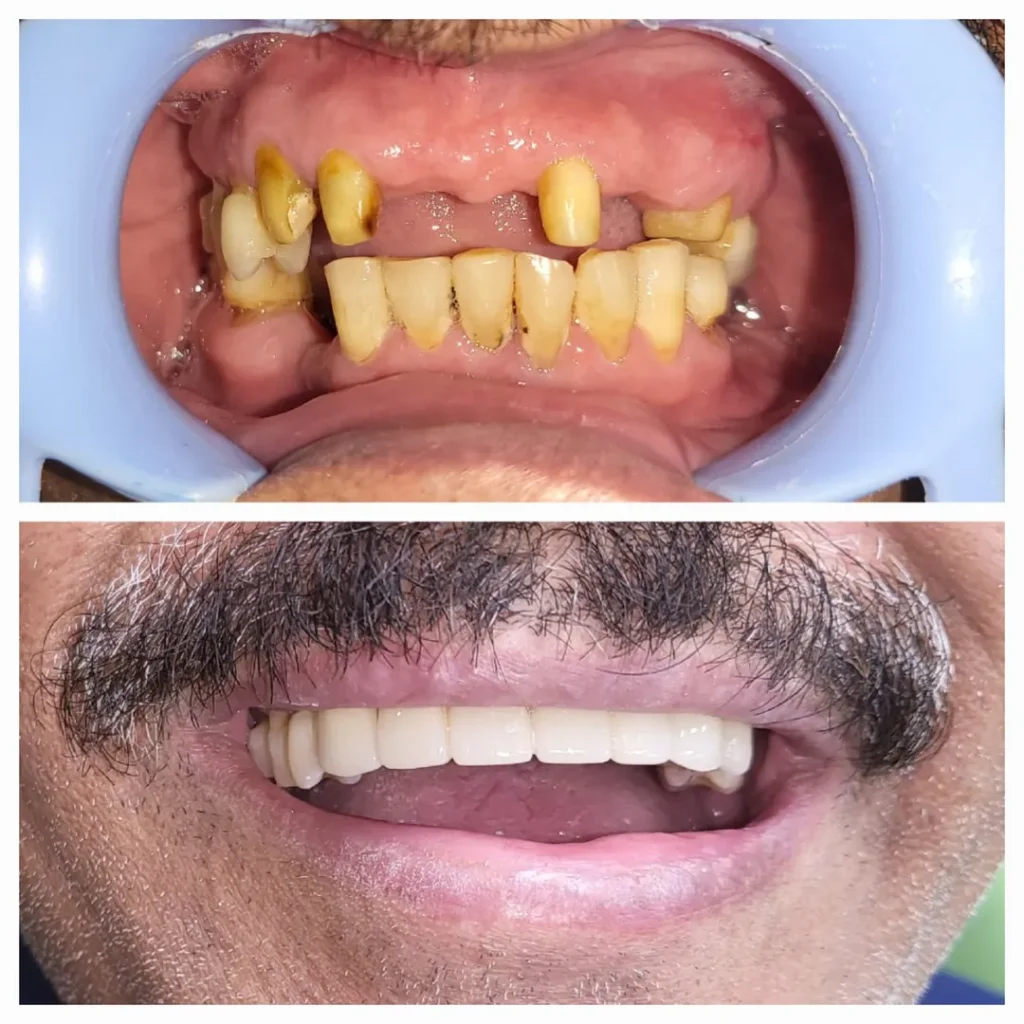 Before-and-after dental restoration: top row shows severely decayed, missing upper teeth; bottom row shows a full, white smile after treatment.