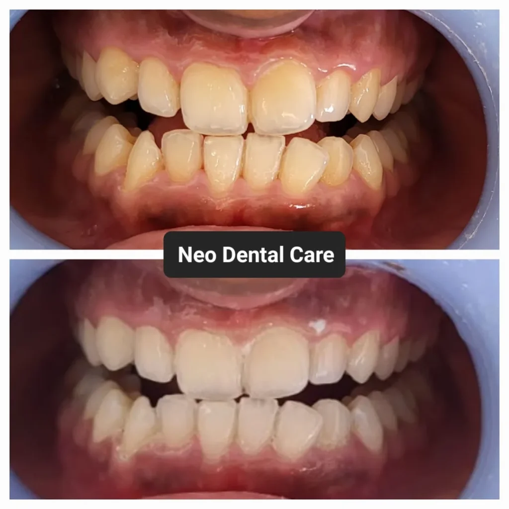 Two-panel before/after dental photo showing crowded yellow teeth improved after treatment at Neo Dental Care.