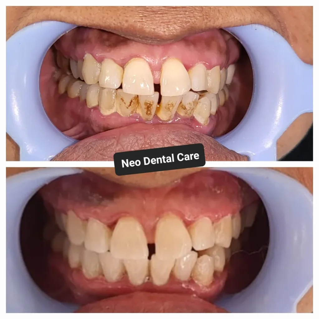 Split-view of dental treatment: top image shows crowded, stained teeth with heavy tartar; bottom image shows whiter, cleaner teeth with improved alignment and a gap between the front teeth.