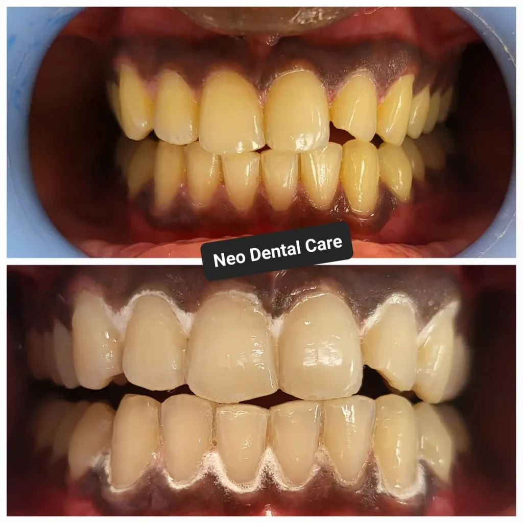 Before-and-after dental treatment: top image shows misaligned, yellowed teeth; bottom image shows improved alignment and whitening.