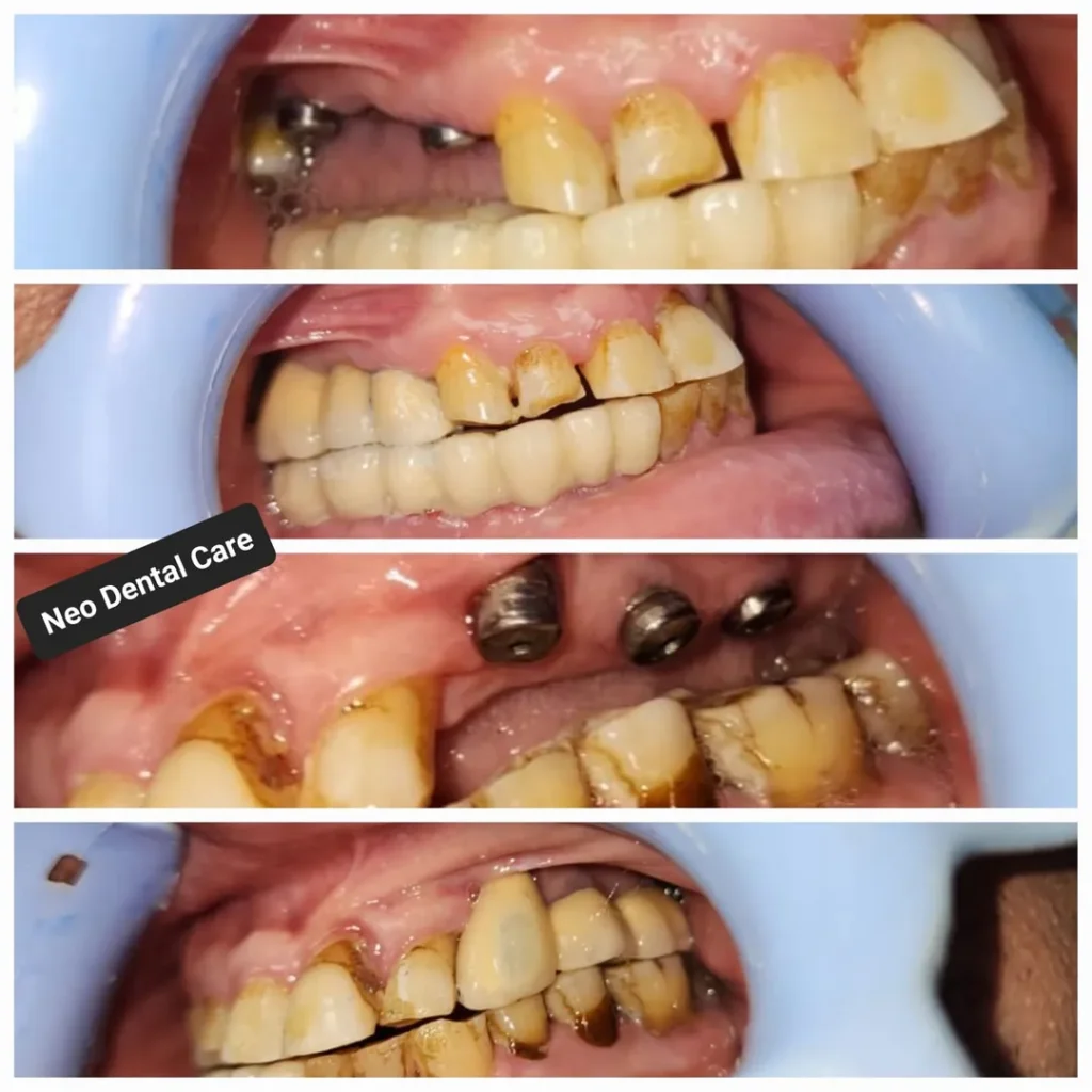 Series of dental restoration images showing decayed teeth, implants, and final crowns on upper and lower jaws.