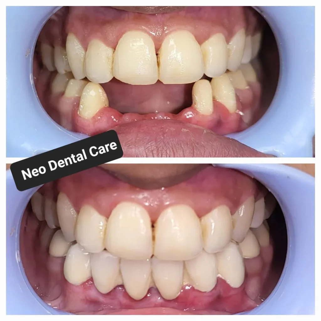 Two-panel before-and-after dental treatment: crowded, uneven teeth on top image and straighter, cleaner teeth after care in the bottom image (Neo Dental Care).