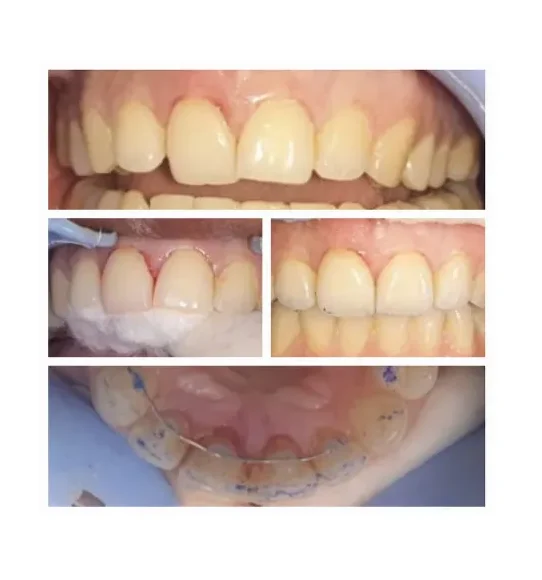 Collage showing dental treatment progress: crowded upper front teeth in the top image, close-ups of before-and-after alignment in the middle photos, and a dental impression mold with blue markers in the bottom image.