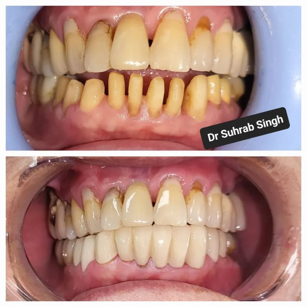 Before-and-after dental photos: severely stained, crowded teeth improved to straight, white dentition after treatment.