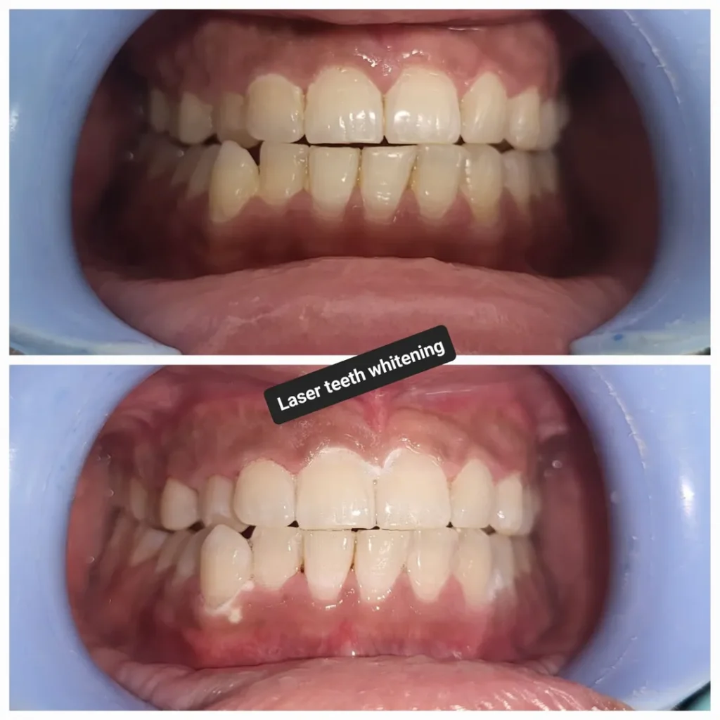 Before (top) and after (bottom) laser teeth whitening showing whiter, brighter teeth in both arches.