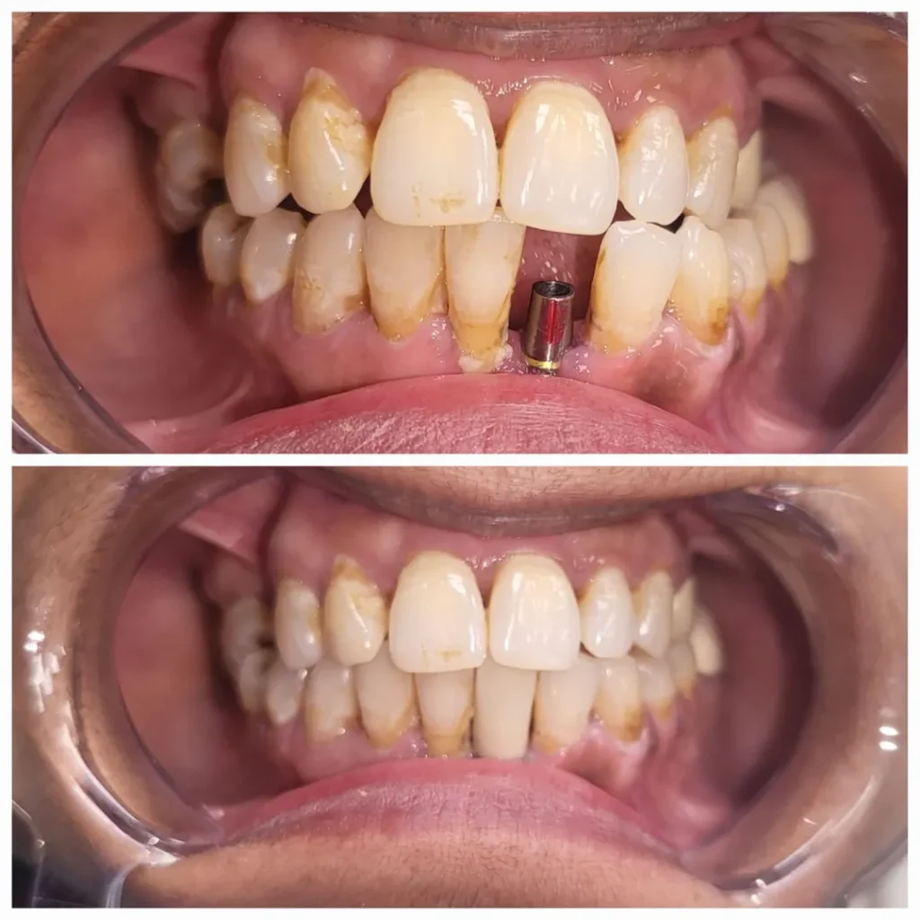Before and after views of lower front teeth showing a dental implant post and improved alignment after treatment.