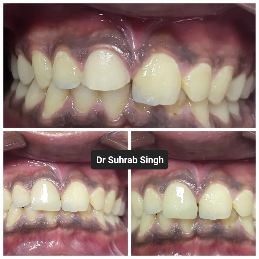 Collage of a patient’s teeth from front and sides showing crowded bite; labeled with 'Dr Suhrab Singh' in the center, illustrating dental alignment before/after treatment.