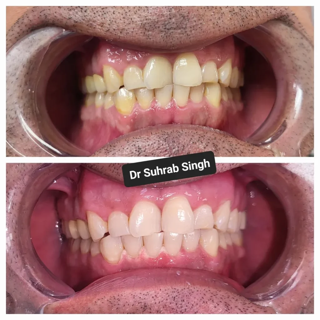 Before and after dental treatment: upper and lower teeth alignment improved, with 'Dr Suhrab Singh' label across the middle.