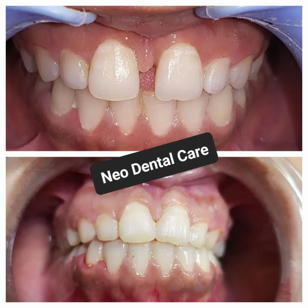 Before-and-after photos show improved dental alignment: top image with crowded front teeth, bottom image with straighter bite after treatment at Neo Dental Care.