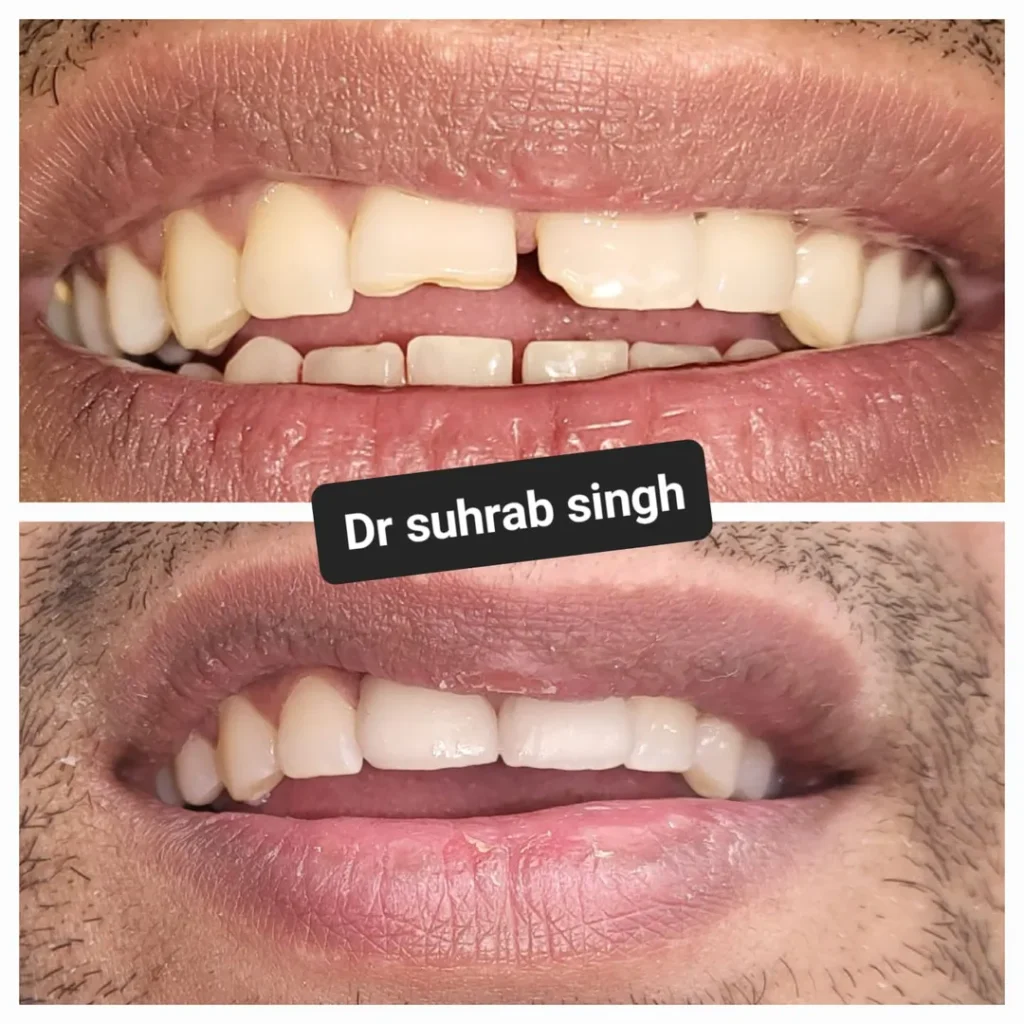 Split-screen before-and-after dental photo: top shows crowded, discolored front teeth; bottom shows straight, white front teeth after treatment.